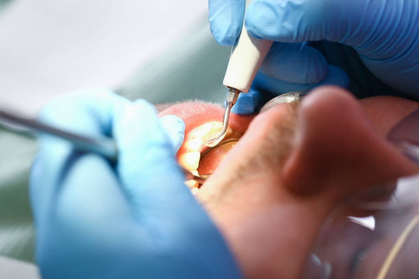 Best Emergency Tooth Extraction in Irvine, CA