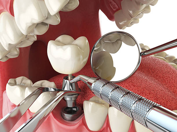 Best Emergency Treatment for Toothache in Irvine, CA